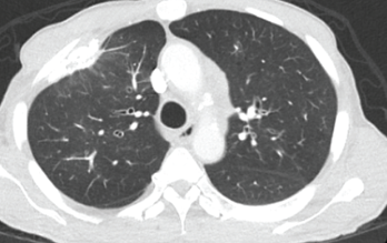 This chest CT shows improved aeration of the left upper lobe compared with Figure 1. 