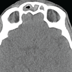 Figure 3. This sinus CT shows severe nasomucosal disease with near complete opacification of the bilateral frontal sinuses. 