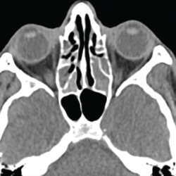 Figure 4. This sinus CT shows severe nasomucosal disease with near complete opacification of the bilateral ethmoid sinuses. 