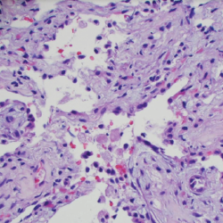 Figure 5. A transbronchial lung biopsy showed bronchiole walls containing scattered infiltrates of eosinophils in the adventitia. 