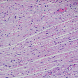 Figure 6. A sural nerve biopsy demonstrated arteries in longitudinal sections with thrombosis and eosinophilic infiltrate, consistent with vasculitis. 