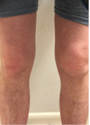 Figure 1: The patient provided photos of both knees. Note the swelling in suprapatellar bursa and loss of medial/lateral peripatellar fossa. 