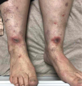 Image 1: Both of the patient’s lower legs and feet featured lesions. 