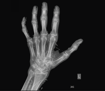 Figure 1: An X-ray of the left hand showed extensive vascular and periarticular calcification. 