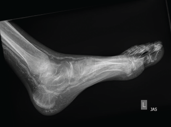 Figure 2: An X-ray of the left foot showed extensive vascular calcifications and no radiographic evidence of gout.