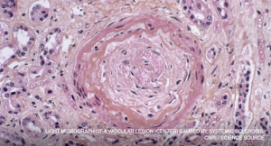Light micrograph of a vascular lesion (center) caused by systemic sclerosis.