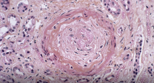 Light micrograph of a vascular lesion (center) caused by systemic sclerosis.