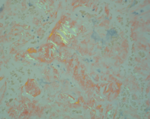 This image shows fibrous tissue with apple-green birefringent material consistent with the presence of amyloid (H&E, 400x).