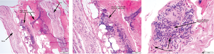 Figures 1, 2 & 3 (from left): The sural nerve biopsy showed vasculitis, perivascular cuffing, and vessels with inflammation and hemosiderin.