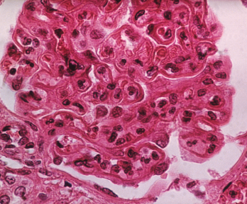 The pattern of lupus glomerular involvement in lupus nephropathy is similar to that in membranous nephropathy, forming wire-loops lesions.