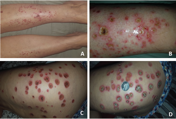 These images show the patient’s RCEV ulcerative skin lesions over two weeks, including image A, which shows an intensely pruritic urticarial rash on her lower legs bilaterally; B, which shows progressive worsening and the development of vesicles and pustules with proteinaceous exudates; C, which shows the formation of eczematous, punched ulcers over her buttocks and thighs; and D, an enlarging ulcer base with crusting (and a Canadian quarter placed to demonstrate ulcer size).