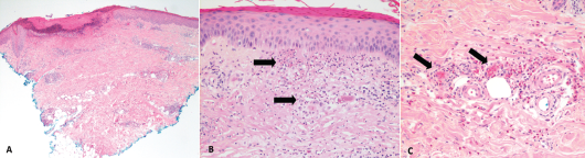 These hematoxylin and eosin stain images show the patient’s histology of RCEV demonstrating vasculitis, including image A, a biopsy from her right leg showing ulceration and superficial and deep perivascular inflammation with vascular damage (magnification 40X); B, a biopsy from her left leg showing cutaneous small vessel vasculitis (the arrows indicate examples of damaged blood vessels) with fibrinoid necrosis of vessel walls and surrounding nuclear debris/leukocytoclasis (magnification 200X); and C, a biopsy from her right leg showing small vessel vasculitis (arrows), uninvolved adjacent small arterioles and abundant perivascular and interstitial eosinophils (magnification 200X). 