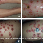 Case Report: Elderly White Woman Presents with Recurrent Skin Lesions