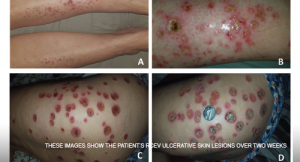 Case Report: Elderly White Woman Presents with Recurrent Skin Lesions