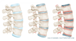 ASDAS Is More Important Than BASDAI in Advanced Ankylosing Spondylitis -  ACR Meeting Abstracts