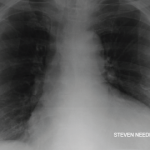 Case Report: Cardiac Tamponade in a Rheumatoid Arthritis Patient