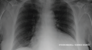 Case Report: Cardiac Tamponade in a Rheumatoid Arthritis Patient