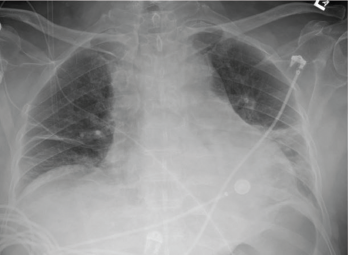 Figure 1: A chest X-ray demonstrated moderate cardiomegaly with tortuous aorta.