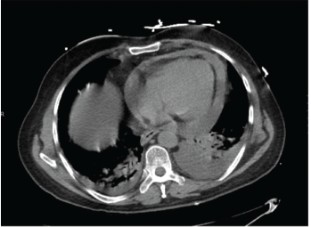 Figure 2: A computed tomography angiogram of the chest showed a moderate-sized complex pericardial effusion.