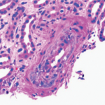 Thickening of the media layer of the vessel with narrowing of the arterial lumen is shown.