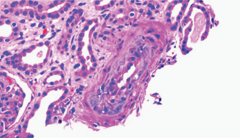 Thickening of the media layer of the vessel with narrowing of the arterial lumen is shown.