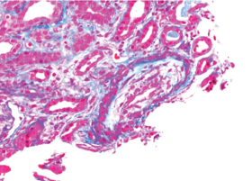 There is necrosis within the media layer of the vessel which is highly indicative of scleroderma renal crisis.