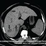 A CT of the abdomen demonstrated numerous hypodense lesions present in both lobes of the liver, with the largest lesion measuring 2.0 x 3.1 cm.