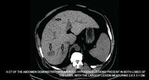 A CT of the abdomen demonstrated numerous hypodense lesions present in both lobes of the liver, with the largest lesion measuring 2.0 x 3.1 cm.