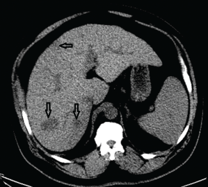 Figure 1. A CT of the abdomen demonstrated numerous hypodense lesions present in both lobes of the liver, with the largest lesion measuring 2.0 x 3.1 cm.