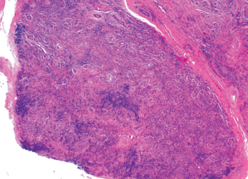 Figure 2. An ultrasound-guided biopsy revealed necrotizing granulomatous inflammation in the liver.