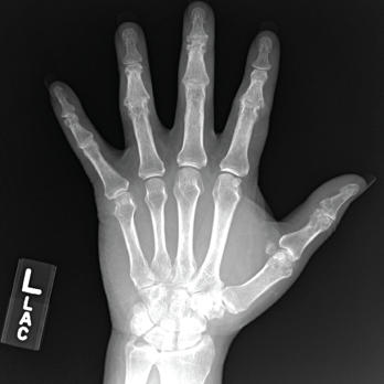 Figure 3. An X-ray of the patient’s left hand showed numerous erosions with overhanging edges due to gout.