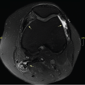 An MRI of the patient’s left knee with and without IV contrast. The knee featured diffuse pigmented villonodular synovitis, including within a lobulated Baker’s cyst, without substantial change in disease burden dating back to 2017. 