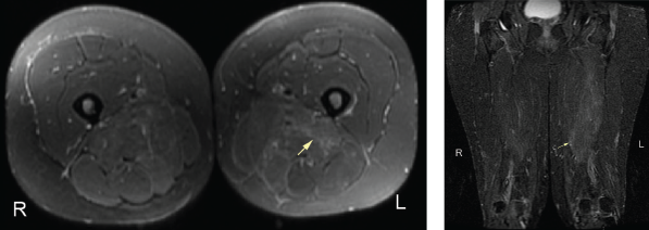 Figure 2. An MRI of the patient’s left and right femur without IV contrast. Note the mild diffuse muscle edema in the adductor magnus and semimembranosus muscles bilaterally, the left greater than right. 