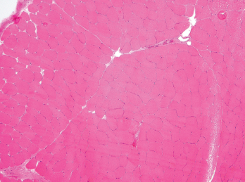 Figure 3. A biopsy of the patient’s left quadriceps muscle. Note the scattered atrophic fibers, mainly type 2. There is no myonecrosis, regeneration, inflammation or significant immunohistochemical upregulation of MHC class I and II. 