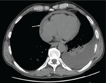 Figure 1: Pericardial effusion demonstrated on a CT of the chest. The arrow indicates the effusion.