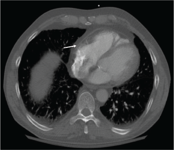 Figure 2: Resolution of the pericardial effusion was indicated on the chest CT obtained two months after initiation of rituximab infusions.