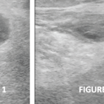 Figures 1 & 2: Transverse and longitudinal ultrasound views, respectively, of the left posterior knee, revealing a cystic mass with heterogeneous internal echotexture and no stalk.