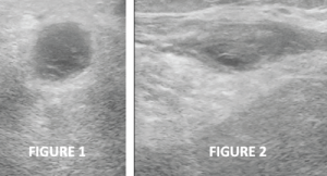 Figures 1 & 2: Transverse and longitudinal ultrasound views, respectively, of the left posterior knee, revealing a cystic mass with heterogeneous internal echotexture and no stalk.