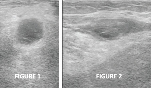 Figures 1 & 2: Transverse and longitudinal ultrasound views, respectively, of the left posterior knee, revealing a cystic mass with heterogeneous internal echotexture and no stalk.