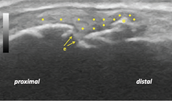 Figure 3: Longitudinal ultrasound view of the left second metacarpophalangeal joint demonstrating diffuse synovitis (*), metacarpal head discontinuity due to bone and cartilage erosion (e), and a bony osteophyte (o).