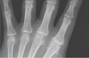 Figure 4: An anteroposterior X-ray of the left hand. Note the metacarpophalangeal (MCP) joint narrowing of digits 2 and 3, osteophytes at the second MCP joint and only mild osteoarthritis at the proximal interphalangeal joints.