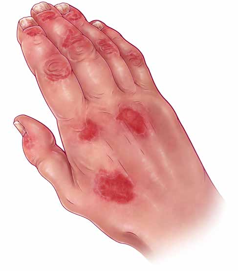 A Rash Of Evidence Evaluating And Treating Psoriatic Arthritis The