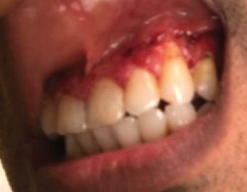 Figure 2. The patient presented with severe, painful, bleeding gingival hypertrophy.