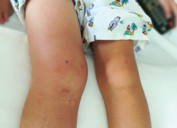 The right knee, swollen in comparison to the left, could be due to acute joint inflammation or infection.