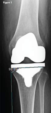 An anteroposterior X-ray of the left knee following the original arthroplasty. It shows a lateral femoral and tibial overhang of 4–5 mm and 3 mm, respectively.