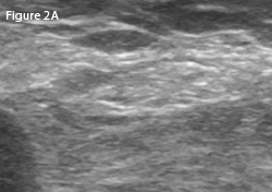Left: A transverse view of the posterolateral left (affected) knee at the level of the fibula. 