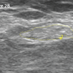 Right: The same view as 2A, with the common peroneal nerve outlined in yellow with a cross-sectional area of 21 mm2.