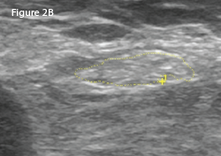 Right: The same view as 2A, with the common peroneal nerve outlined in yellow with a cross-sectional area of 21 mm2.