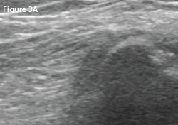 LEFT: A transverse view of the posterolateral right (unaffected) knee at the level of fibula. 