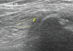 RIGHT: The same view as 3A, with the common peroneal nerve outlined in yellow with a cross-sectional area of 8 mm2.